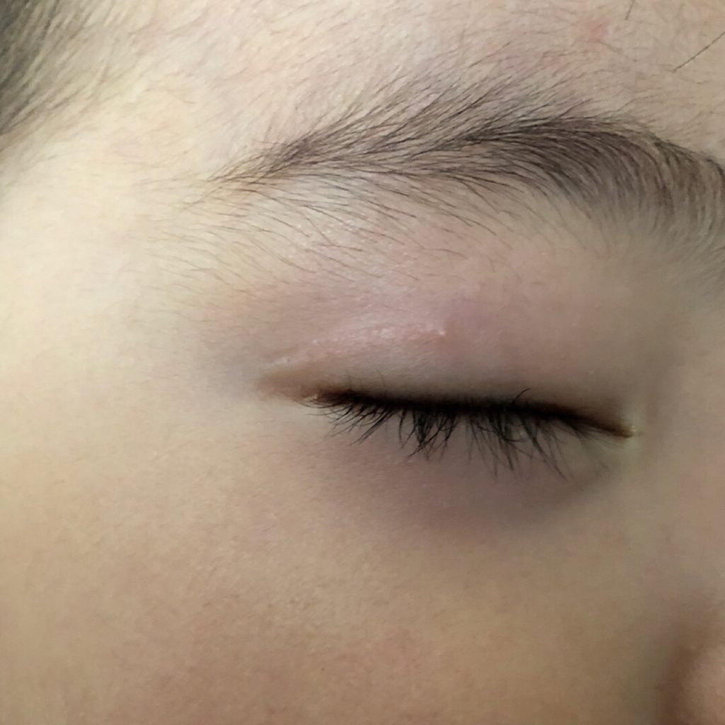体験談 息子がテーブルの角で瞼を強打 パックリ切れ病院へ傷の処置や経過などレビューしてみる Nachii S Blog